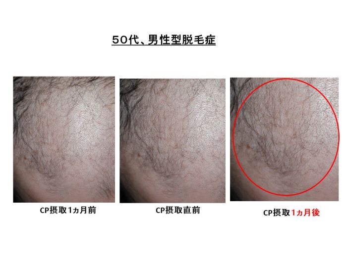 円形脱毛症　病院